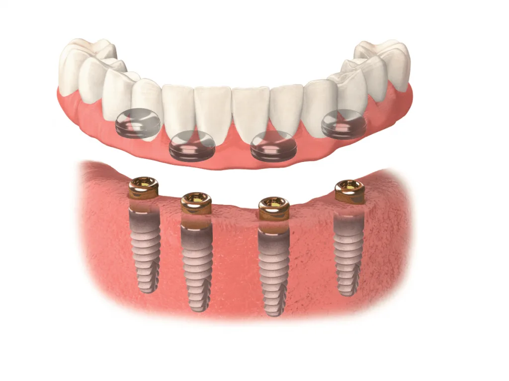 Diagram of a locator-retained overdenture on four implants