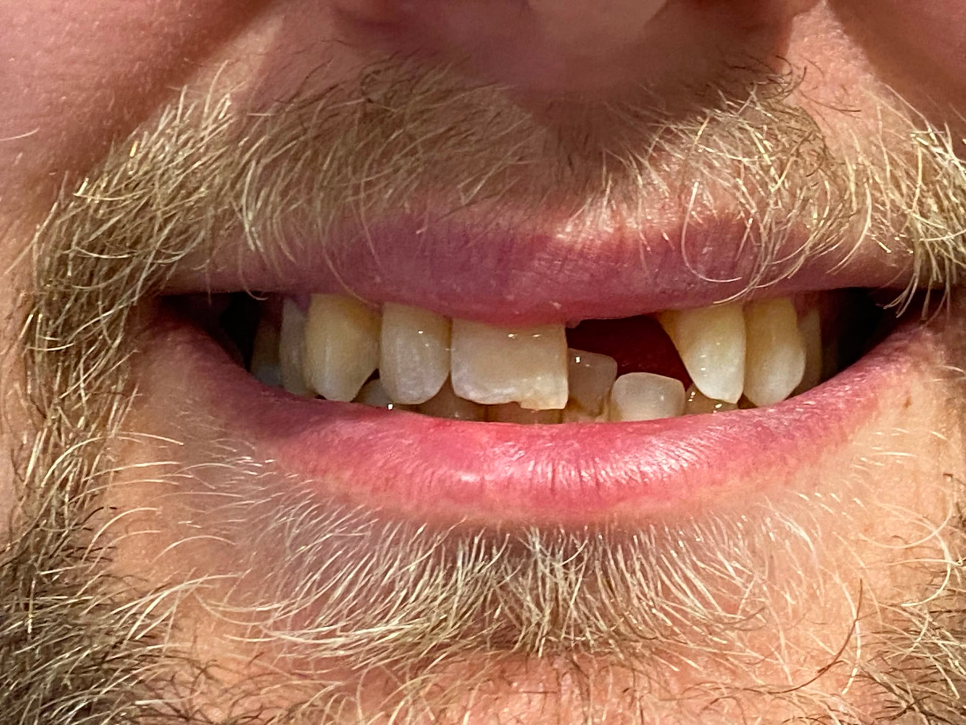 Single upper central incisor implant before implant treatment