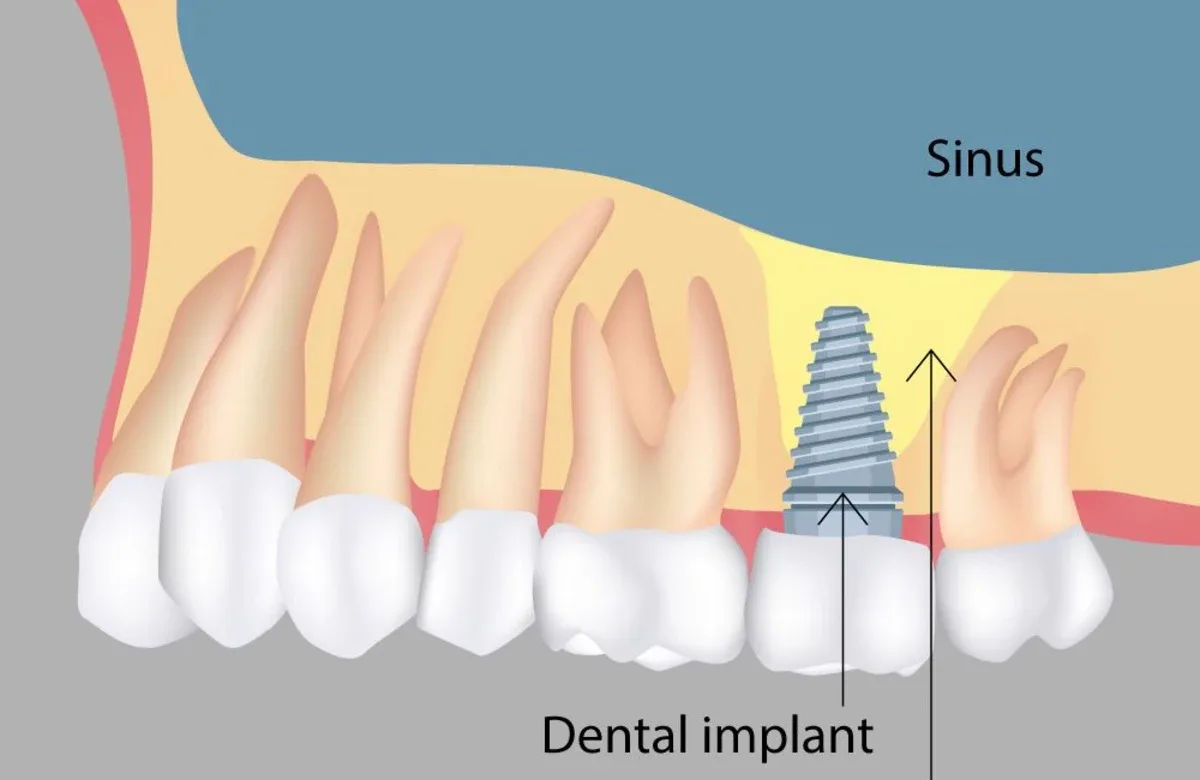 Sinus lift and dental implant diagram showing grafted bone below the sinus