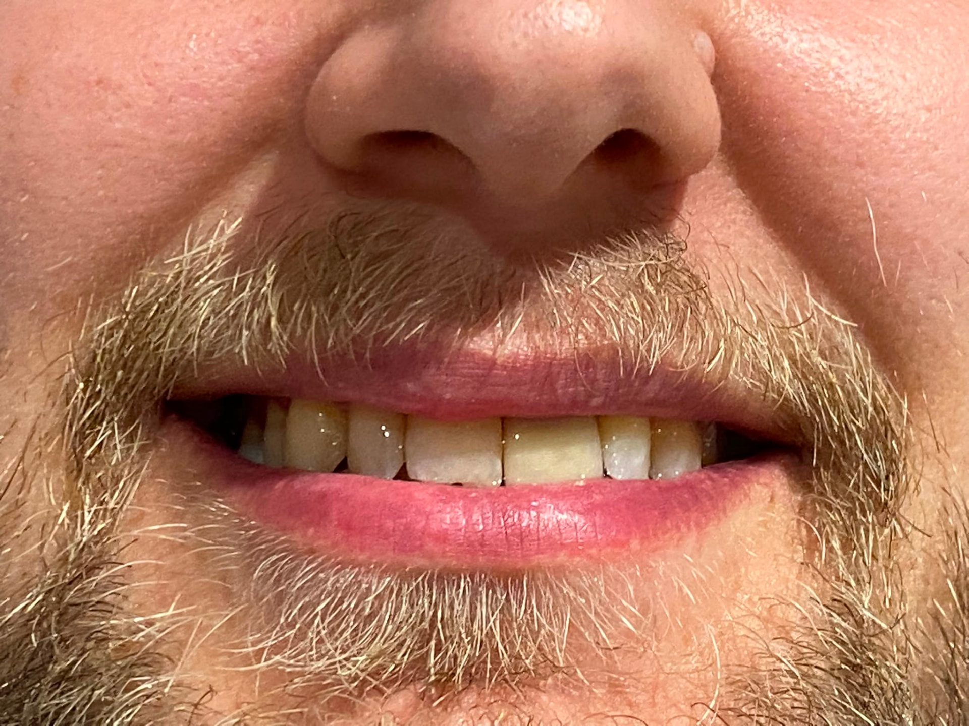 Single upper central incisor implant after implant treatment
