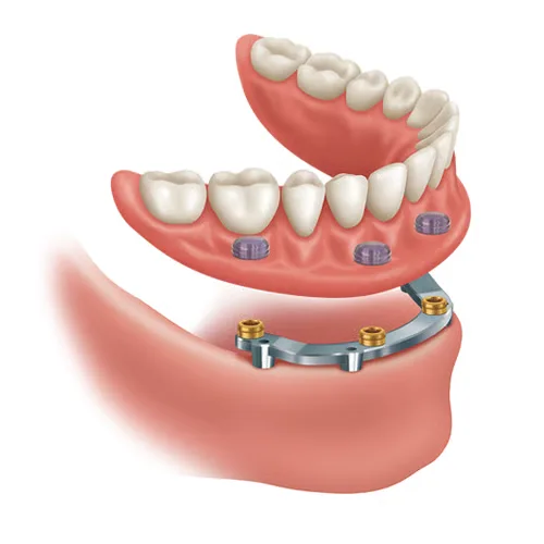 Diagram of a bar-retained overdenture clipping onto implants