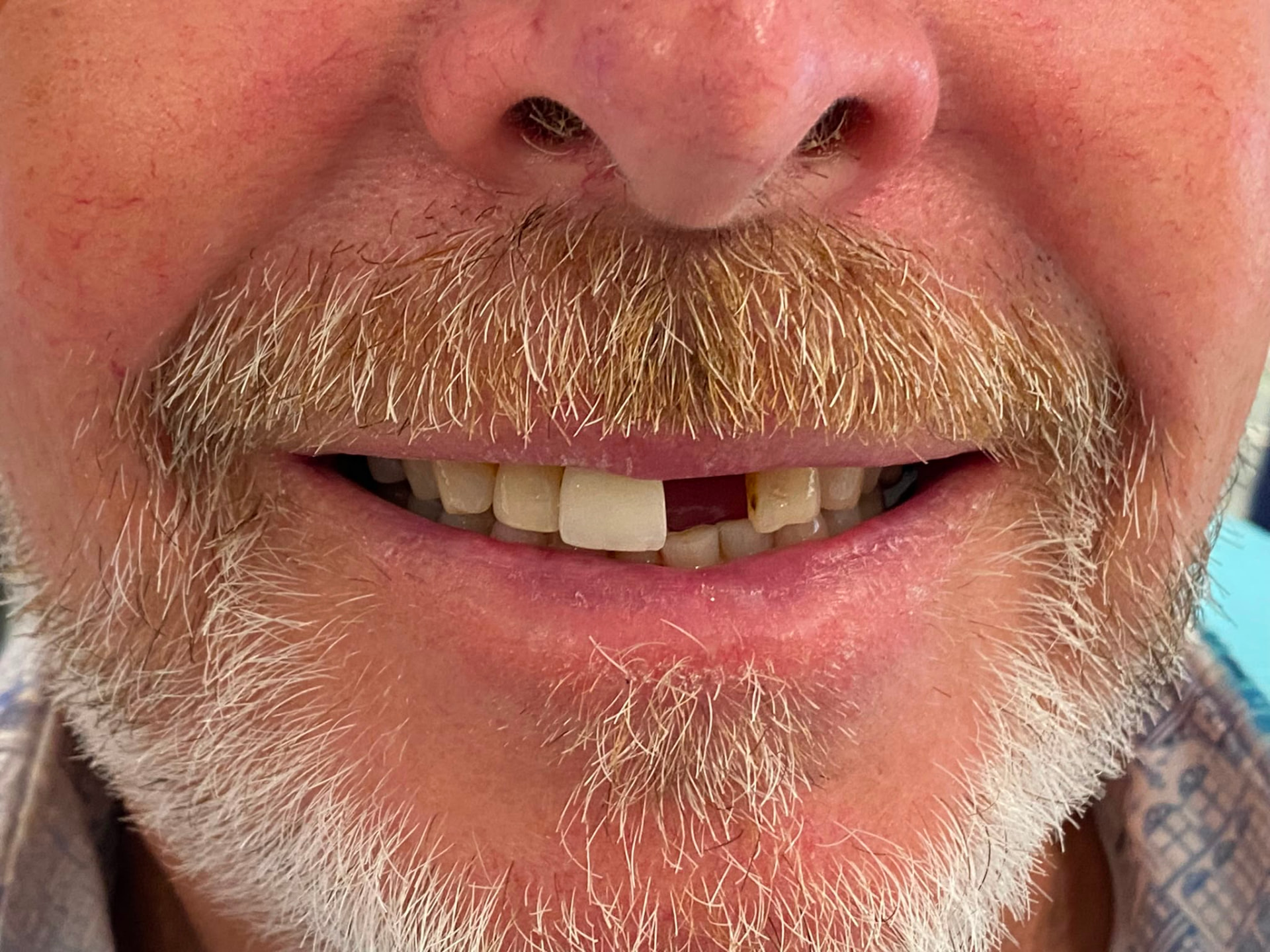 Single implant case, UL1 before implant treatment