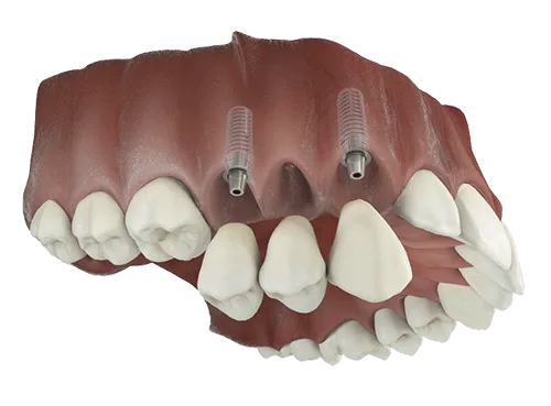 Diagram of an implant-supported bridge replacing multiple missing teeth