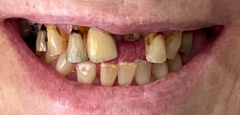 Upper full arch before implant treatment