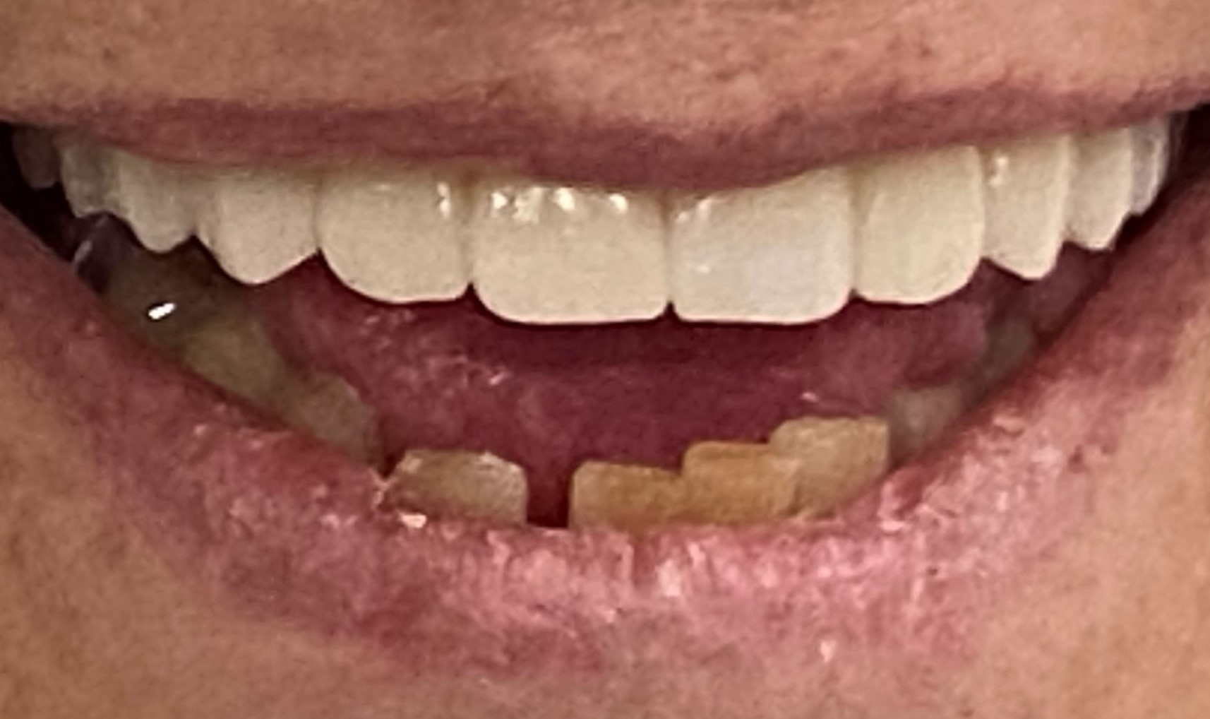 Upper full arch after implant treatment