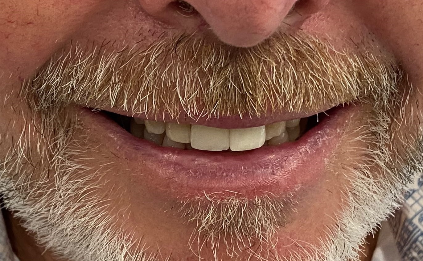 Single implant case, UL1 after implant treatment