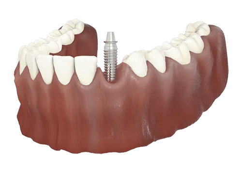 Single dental implant with crown between natural teeth