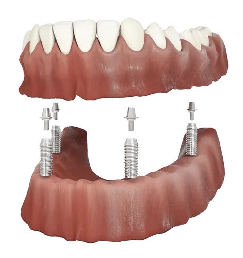 Denture secured onto dental implants