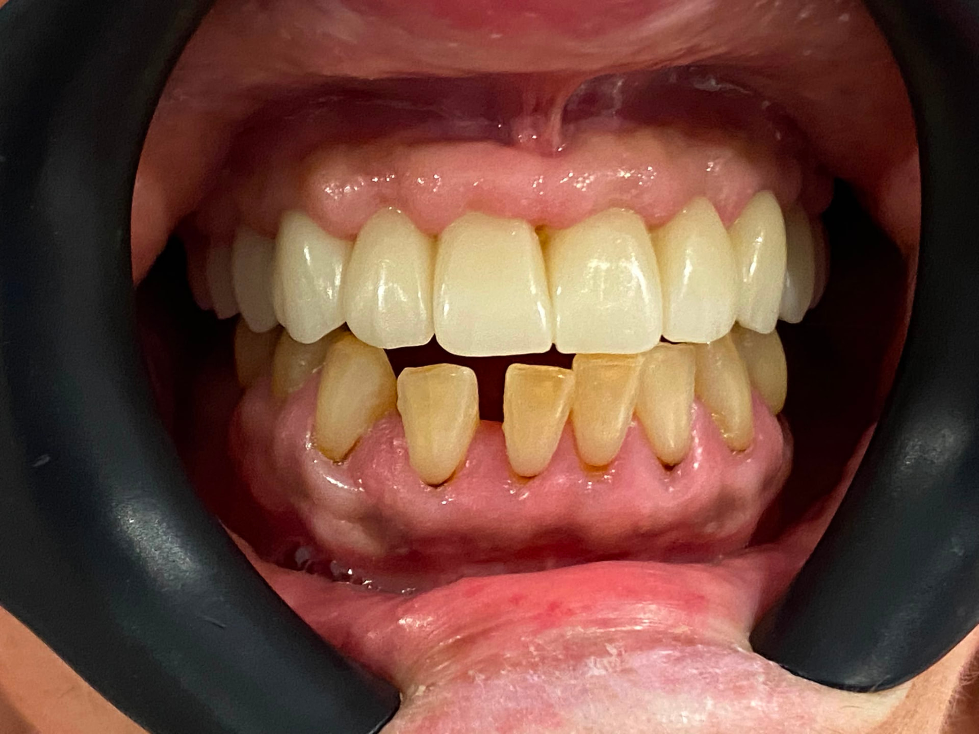 All-on-6 implant placement after implant treatment