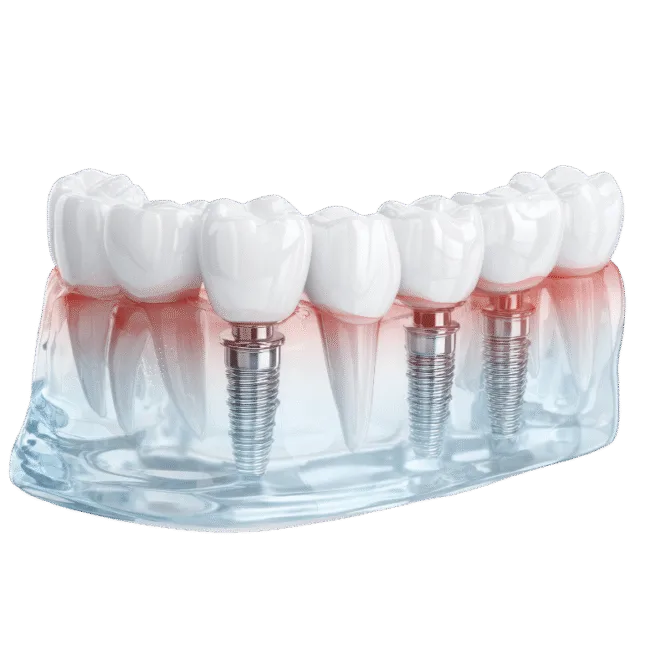 Full arch dental implant bridge